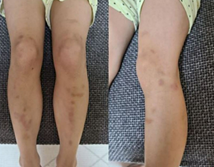 "발달 늦은 8살 딸, 태권도 가서 온 몸에 멍.." 남아들이 속옷 내리고 성추행