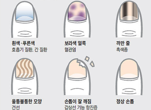 '금이 가고 가로줄'... 손톱이 보내는 건강 적신호