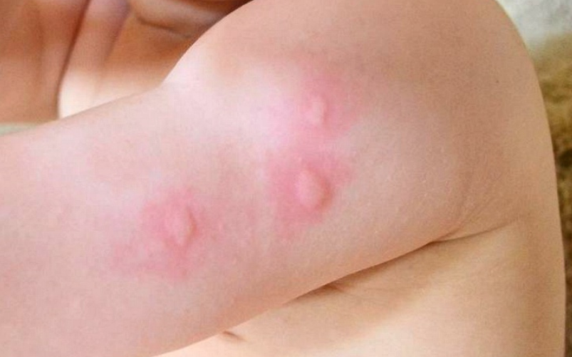 모기 물린 곳 함부로 박박 긁다가는 '봉와직염' 위험↑