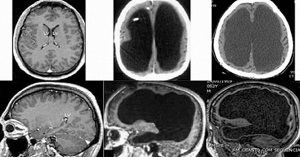 IQ126 우등생이었던 남학생, 알고보니 '뇌가 없었다?!'