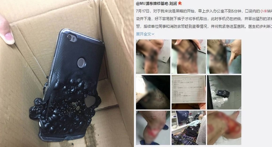 '샤오미폰 폭발 사고'에 허벅지가 새까맣게 탄 피해자